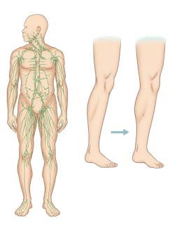 Lymphedema Treatment