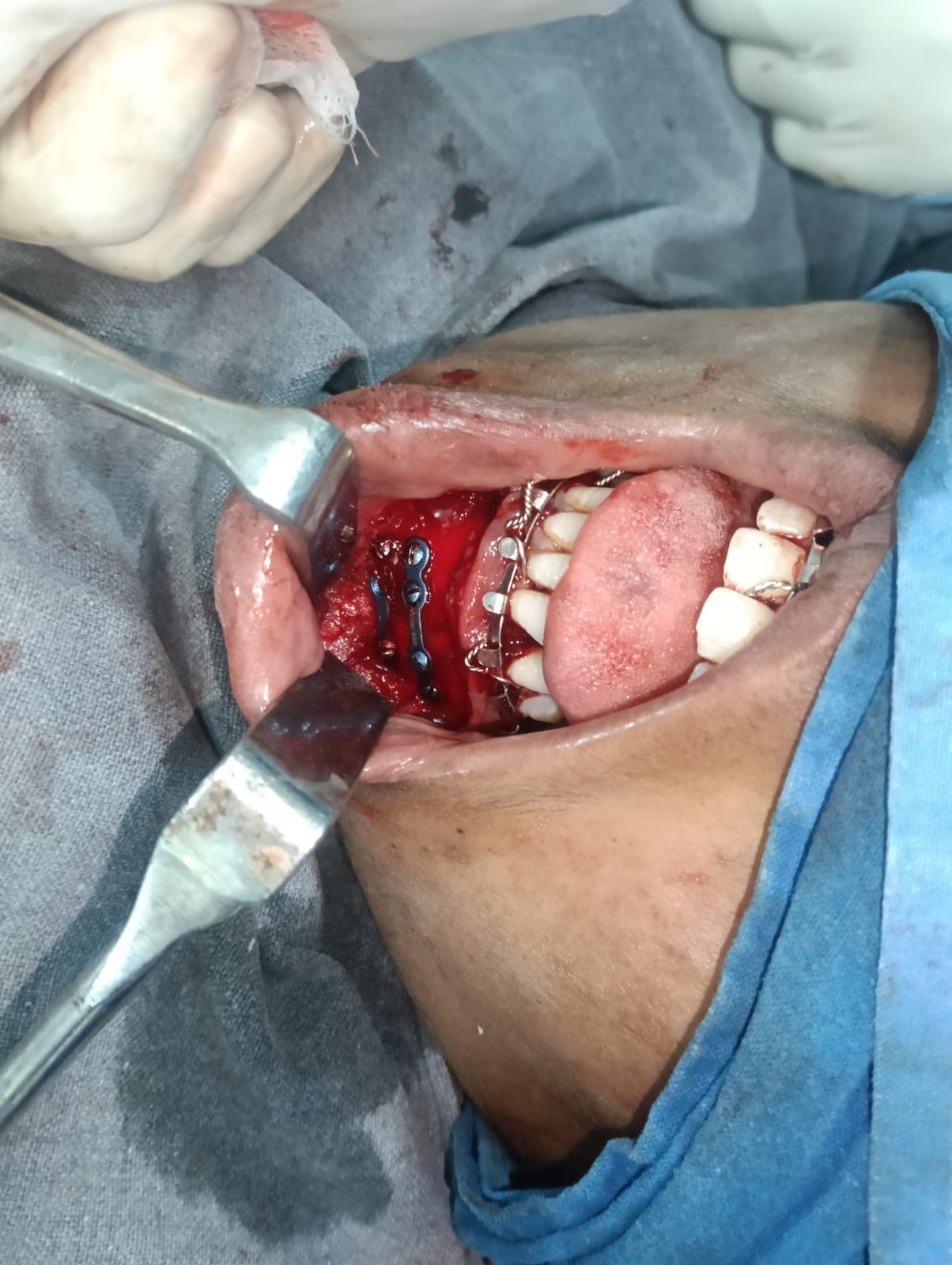 After Reconstruction