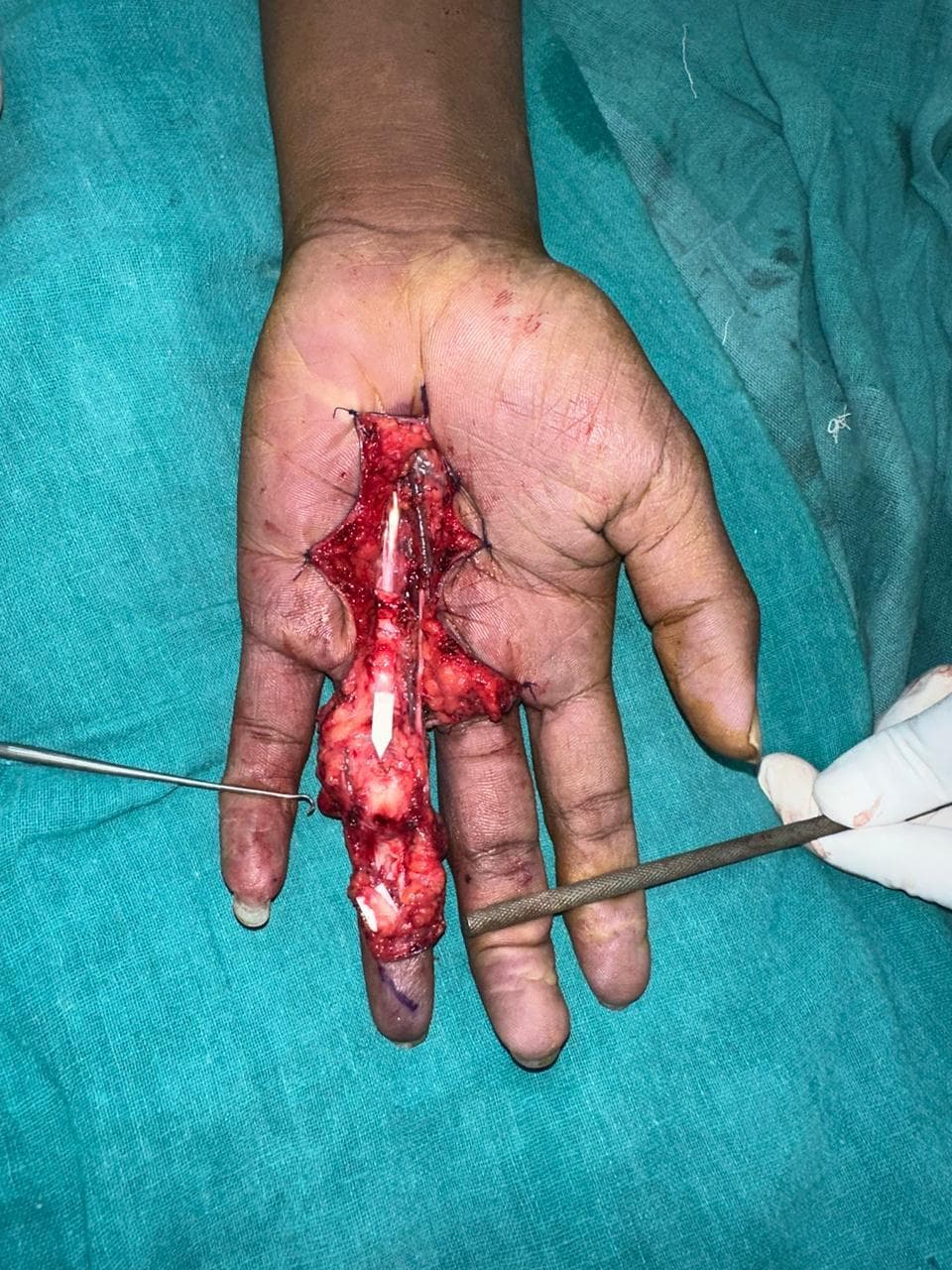 Before Reconstruction