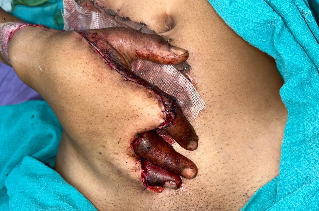 After Reconstruction