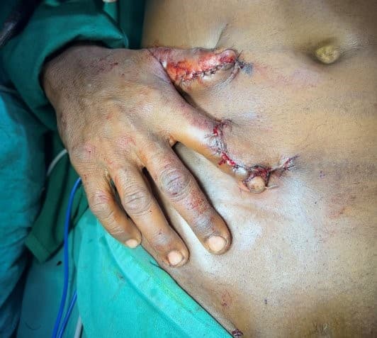 After Reconstruction