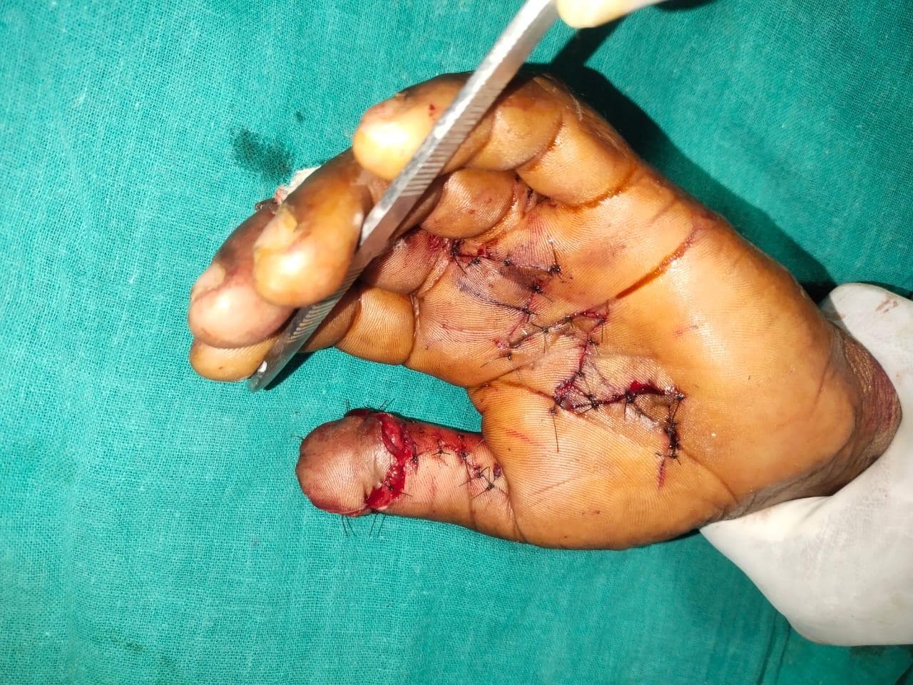 After Reconstruction